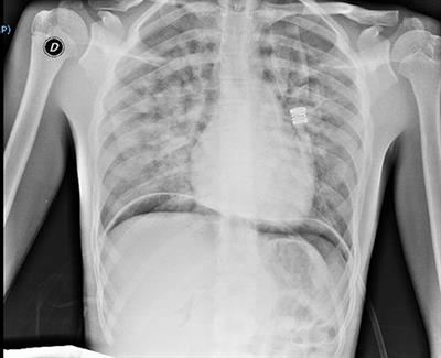 Cannabis-Related Diffuse Alveolar Hemorrhage in a 16-Year-Old Patient: A Case Report